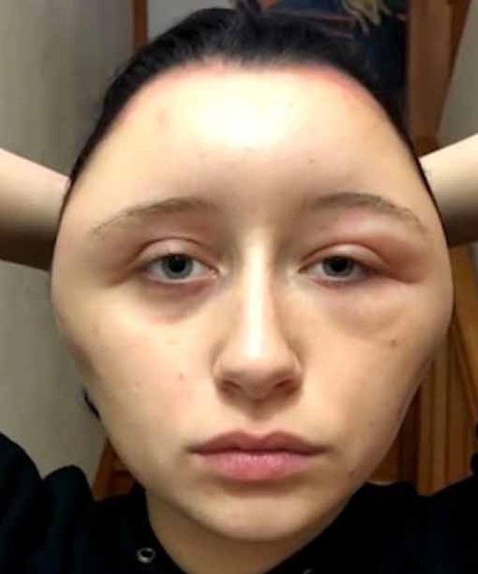 Allergic To Hair Dye Symptoms A French woman suffering an allergic