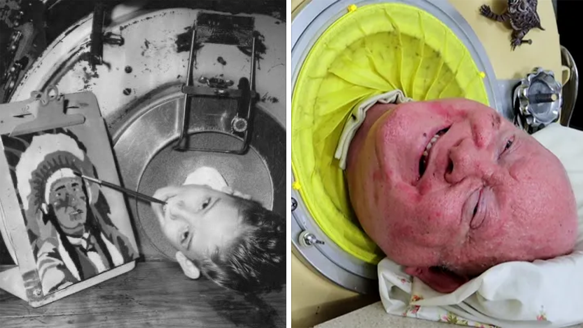 Paul Alexander, The Man Who Lived In An Iron Lung For Over 70 Years Has