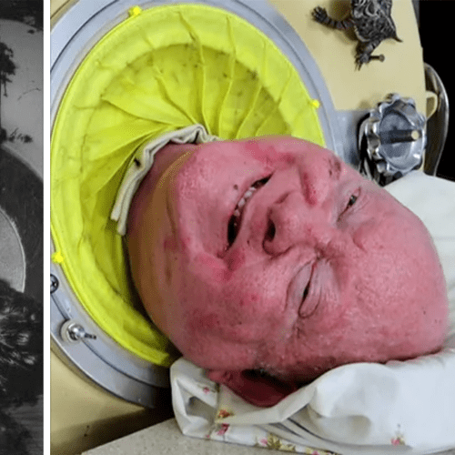 Paul Alexander, The Man Who Lived In An Iron Lung For Over 70 Years Has Died Aged 78